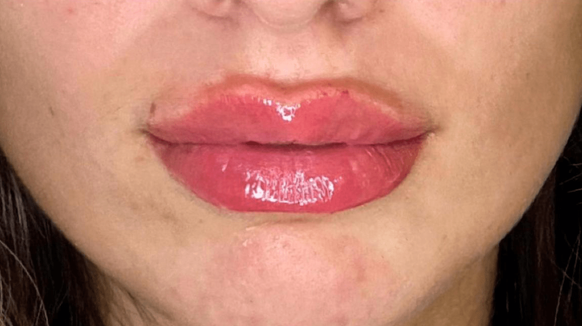 Lips After Img